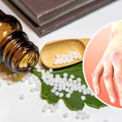 Homeopathy Treatment for Psoriasis